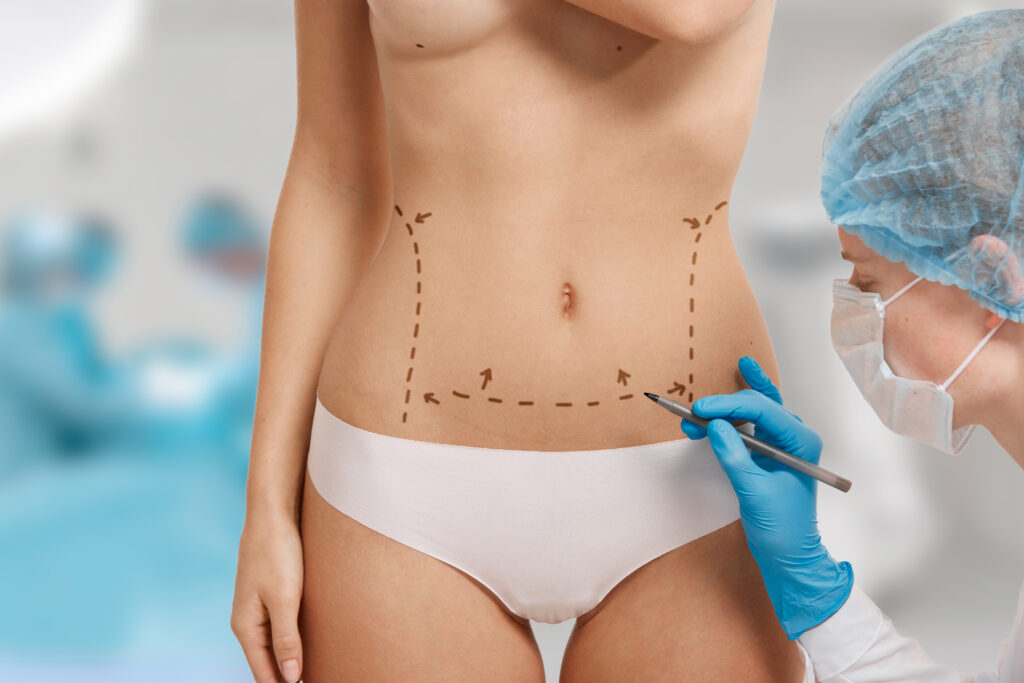 chirurgie esthétique liposuccion